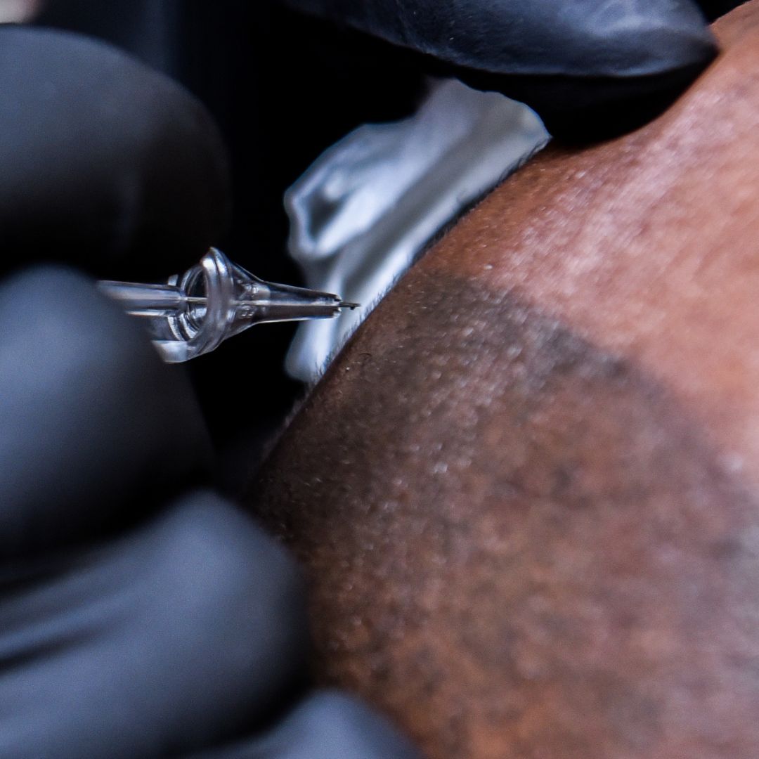 Close-up scalp micropigmentation treatment